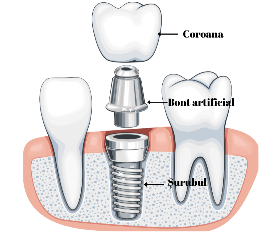 Implant dentar structura