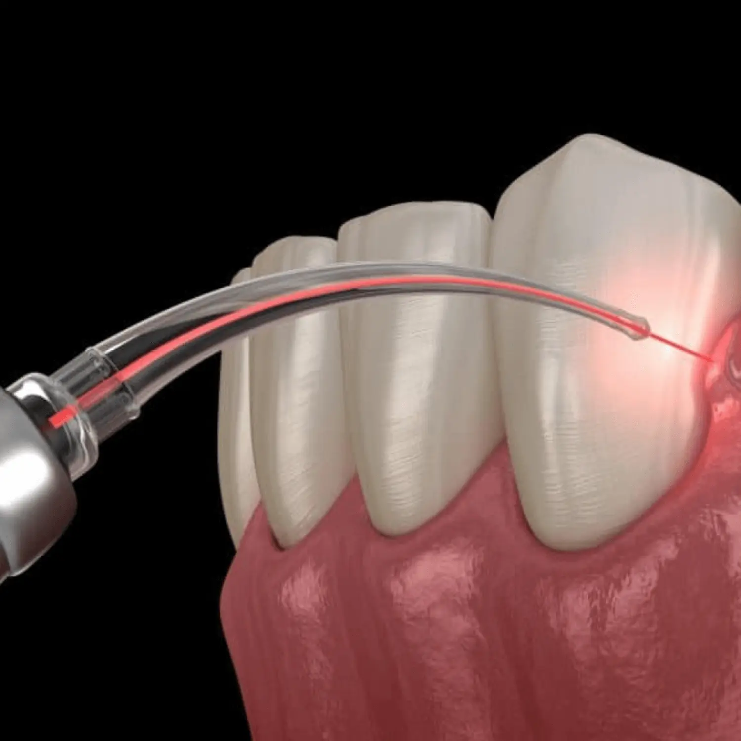 laser dentar satu mare